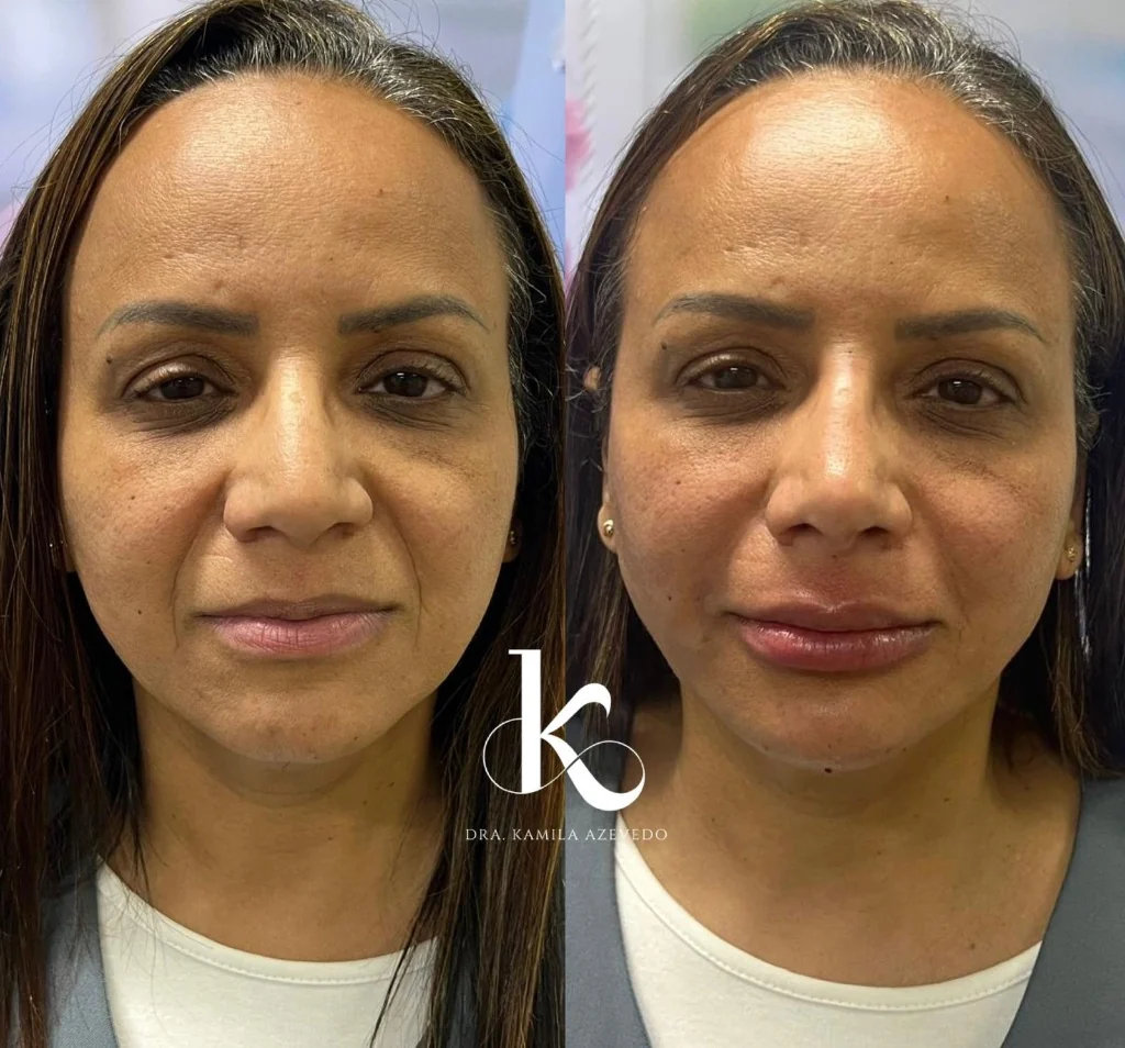 Rejuvenescimento facial antes e depois — botox e bioestimuladores, clínica em Seropédica RJ