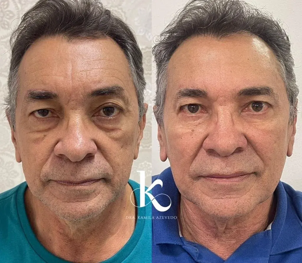 Rinomodelação e contorno facial antes e depois — harmonização sem cirurgia em Seropédica RJ
