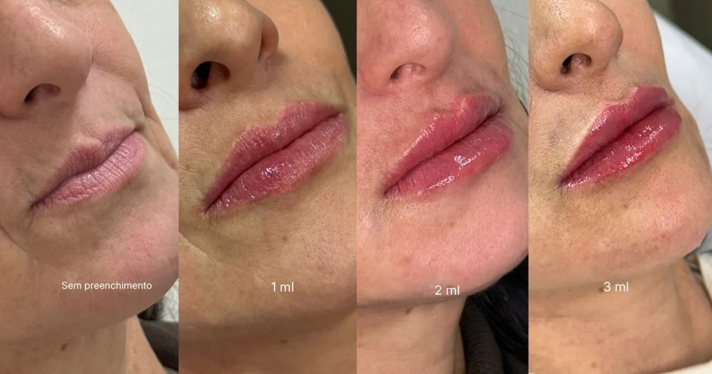 Harmonização facial antes e depois — preenchimento e bioestimulador de colágeno, Dra. Kamila Azevedo