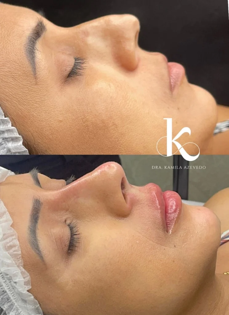 Preenchimento labial com ácido hialurônico antes e depois — resultado natural, Seropédica RJ